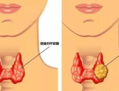 什么是甲状腺腺瘤,病因、临床表现与诊断要点